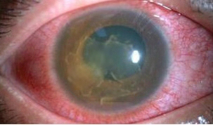 葡萄膜炎,视网膜裂孔,玻璃体出血,珠海希玛眼科