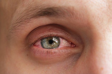 什么是干眼症,怎么治疗干眼症