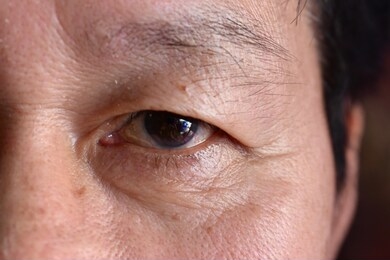 眼睛过度用力会导致白内障,过度使用眼睛会导致白内障吗
