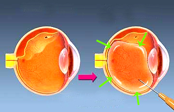 视网膜脱落,手术治疗,中医治疗,视网膜脱离早期