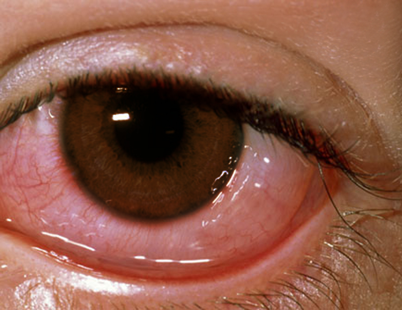 眼睛,越揉,越痒,小心,过敏性,结膜炎,眼睛,