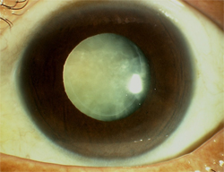 白内障,青光眼,视网膜脱落,黄斑病变,珠海希玛眼