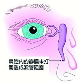 视网膜,视网膜动脉阻塞,眼中风,珠海希玛眼科
