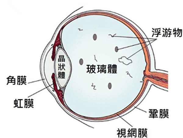 飞蚊症,高度近视,视网膜脱落,珠海希玛眼科医院