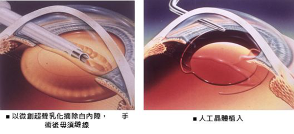 白内障,白内障手术,珠海希玛眼科医院 白内障,白内障手术,珠海希玛眼科医院