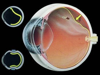 视网膜脱落,珠海视网膜脱落怎么办,视网膜脱落治疗医院