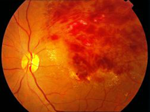 黄斑,视网膜,黄斑区,高度近视,黄斑变病,黄斑怎么治疗