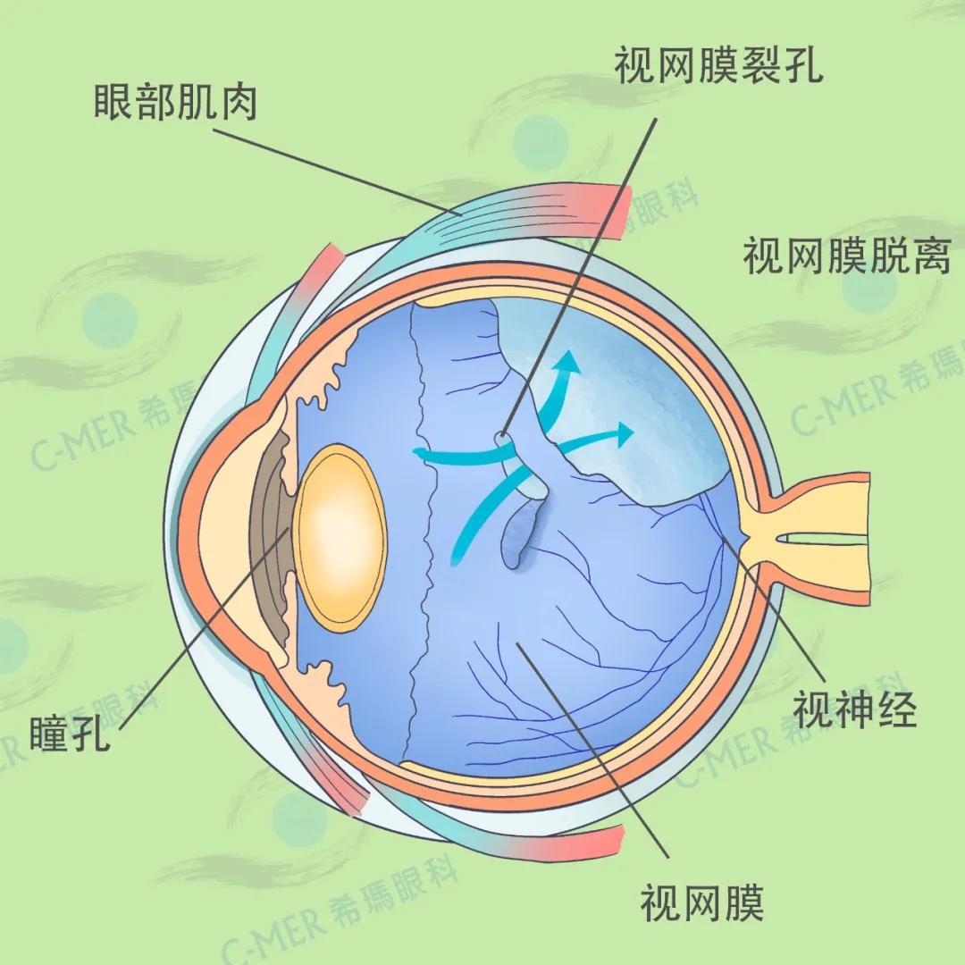 视网膜脱离有何预兆,视网膜脱落的征兆,视网膜脱落早期症状,视网膜脱落最佳手术期