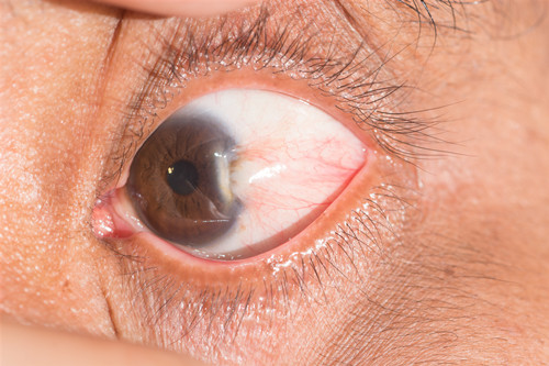 视网膜脱落能自愈吗